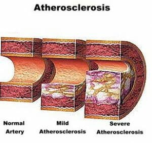 what is arteriosclerotic heart disease