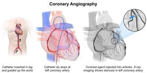 Coronary angiography image