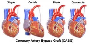 Coronary artery bypass what dissolves plaque from arteries 