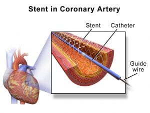 Stent coronary artery image