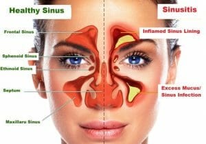 Sinusitis pressure points how to relieve sinus pressure and headache 