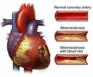 Coronary artery what is CHD d6
