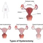 Hysterectomy image