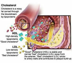 Cholesterol image blood vessel plaque removal 