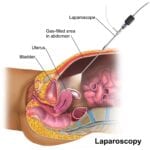 Laparoscopy best supplements for uterine fibroids 