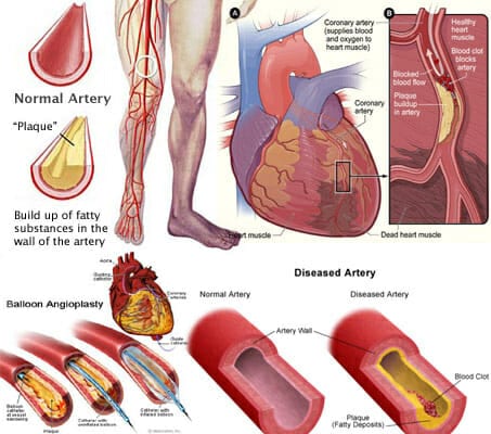 Arterial plaque image what dissolves arterial plaque