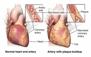 Cardiovascular disease image