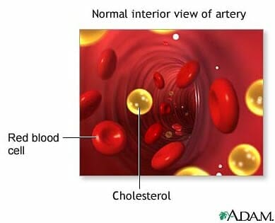 Picture of the interior artery what dissolves arterial plaque 