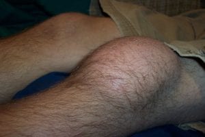 Swollen knee image causes of fluid on the kner