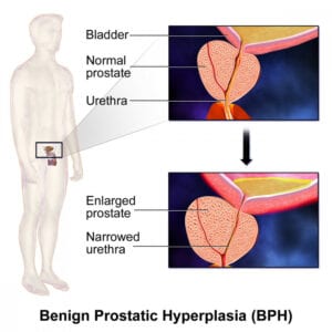 BPE benign prostatic enlargement 
