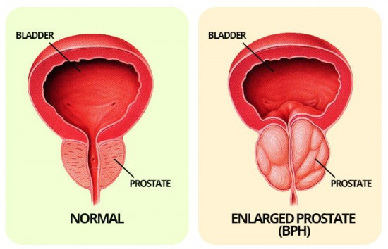 BPH of the prostate