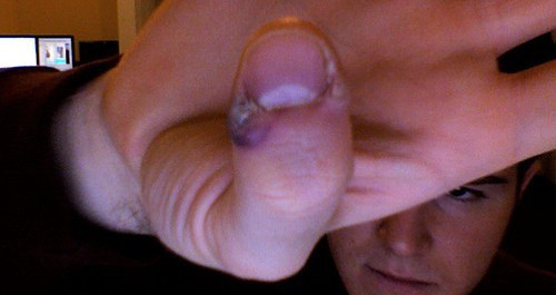 Wart on the thumb image