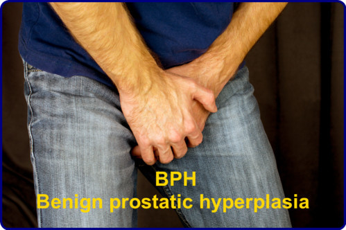 BPH benign Prostatic hyperplasia image