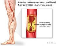 Peripheral arteries what is arteriosclerotic heart disease