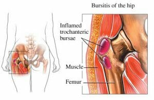 Bursitis of the hip fix hip bursitis 