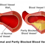 Arterial plaque image