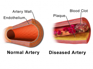 Artery plaque