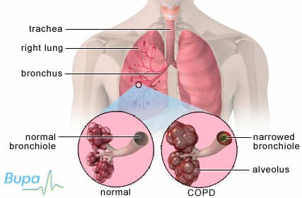 COPD Treatment Options And Tips To Improve Quality Of Life