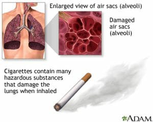 Treatments for COPD emphysema that control the symptoms