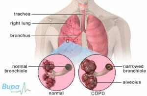 copd image