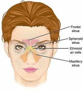 Sinusitis image