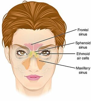 Sinusitis image