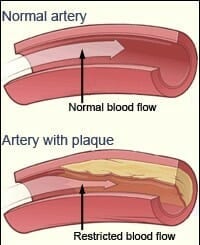 Blocked arteries clean arteries from plaque 