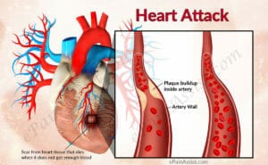 Heart attack image