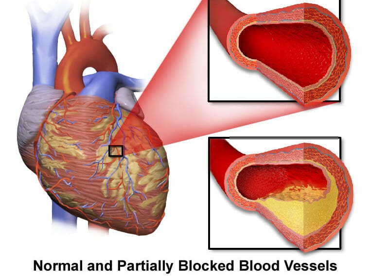 Can arteries be unclogged?