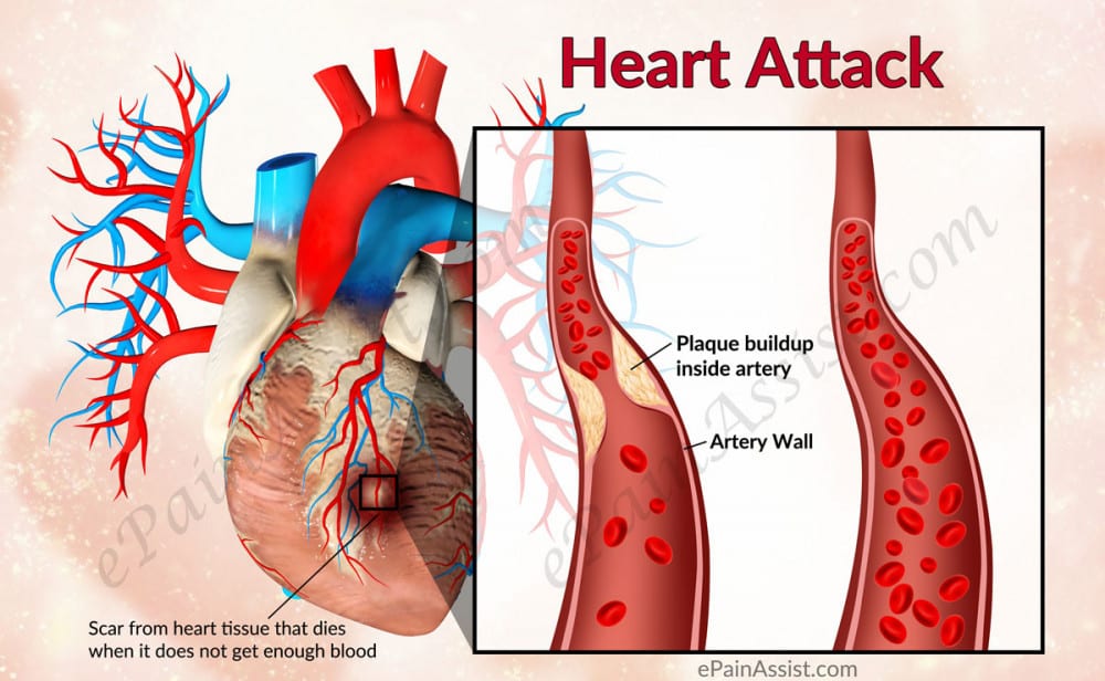 Plaque in arteries