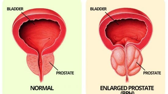 Enlarged prostate